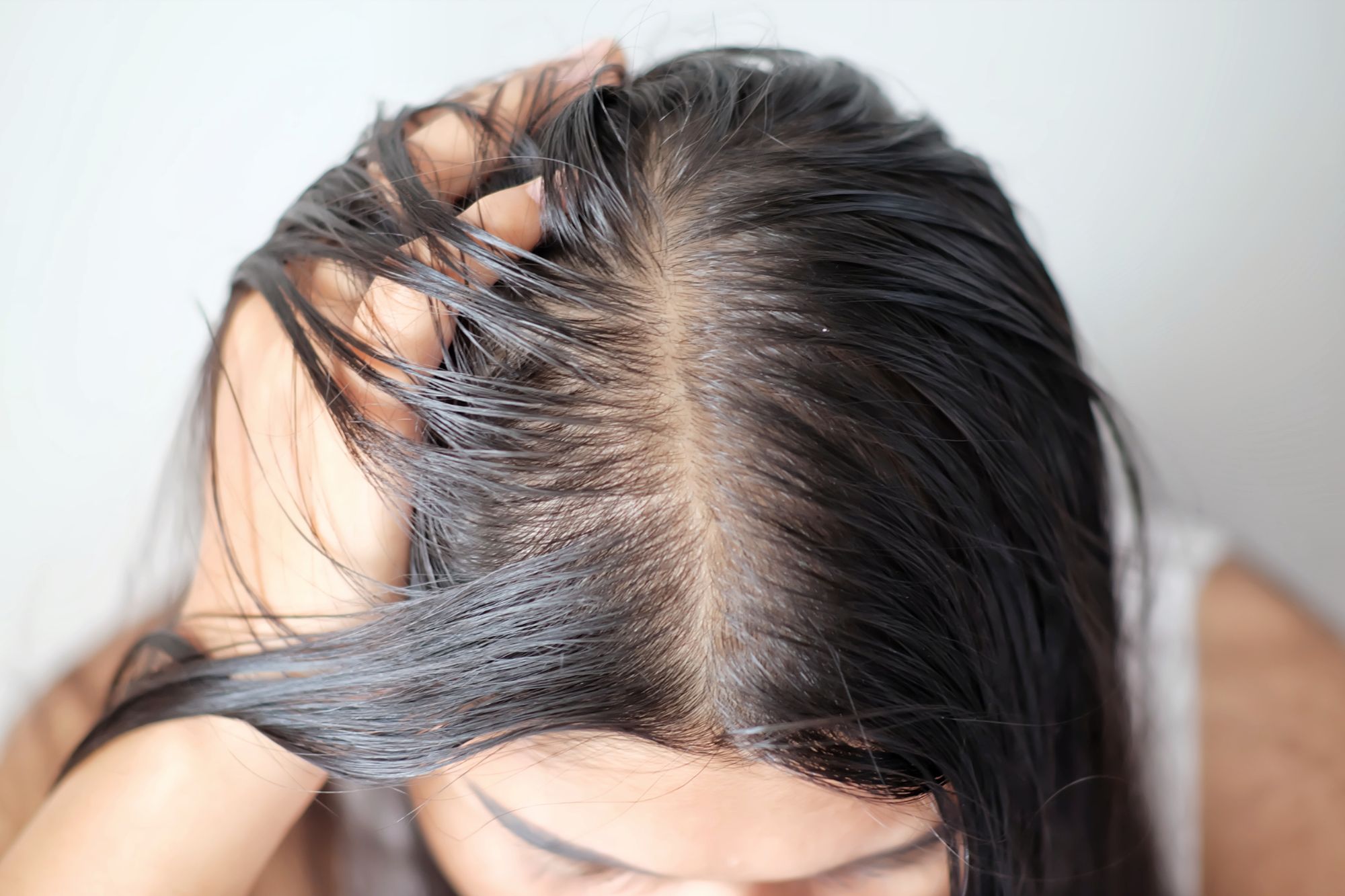 脂溢性脫髮初期難以察覺，大多數患者發現時已屬於中後期。