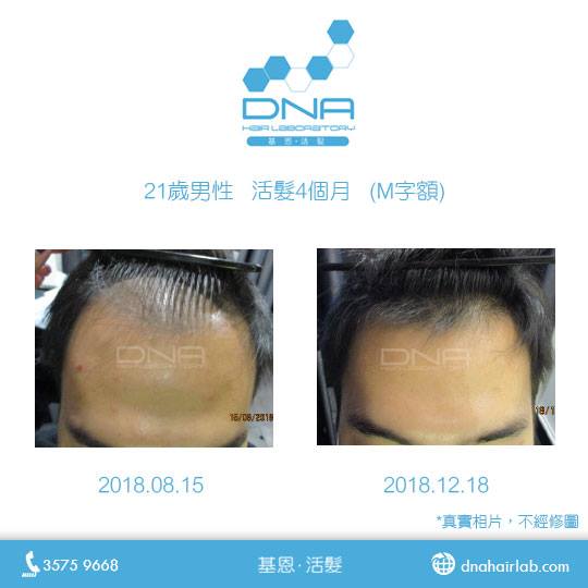 21歲男性m字額活髮案例 Dna Hair Lab