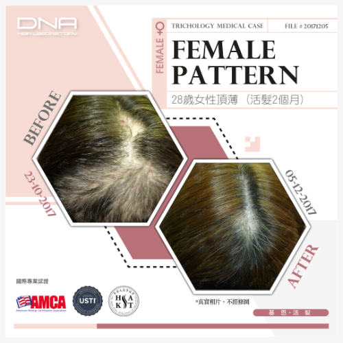 Severe Scalp Inflammation from Trichotillomania – 2-Month Recovery