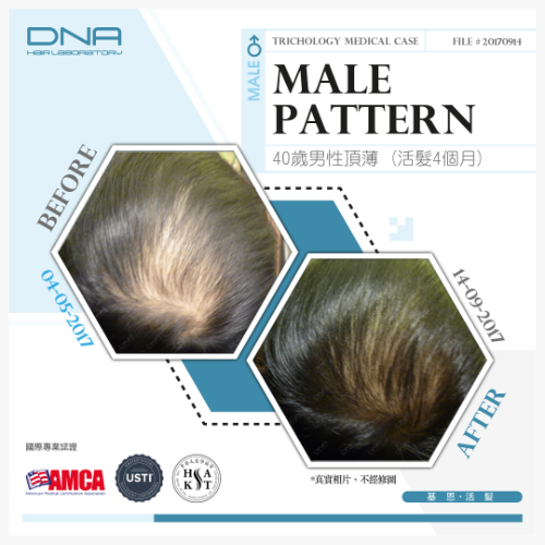 Scalp Oil Neglect Caused Hair Loss in 34-Year-Old – 4-Month Recovery